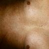 Cutaneous Mastocytosis Tel Macul Perstans