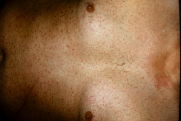 Cutaneous Mastocytosis Tel Macul Perstans