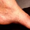 Urticaria Pigmentosa Mastocytosis (11)