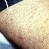 Urticaria Pigmentosa Mastocytosis (3)