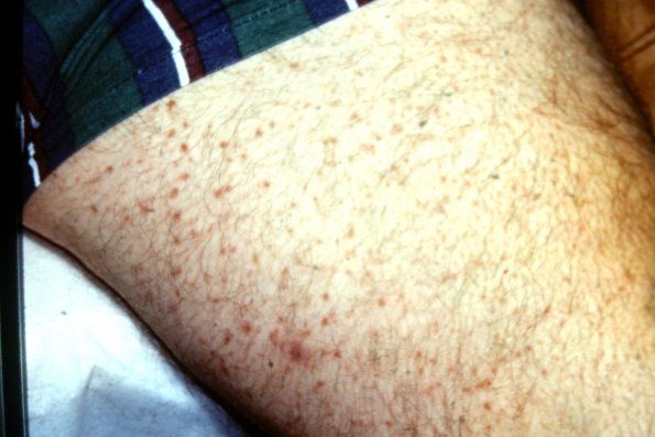 Urticaria Pigmentosa Mastocytosis (4)