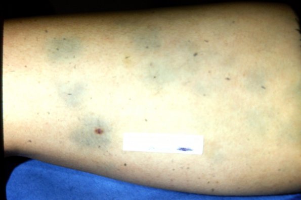 Minocycline Hyper Pigmentation