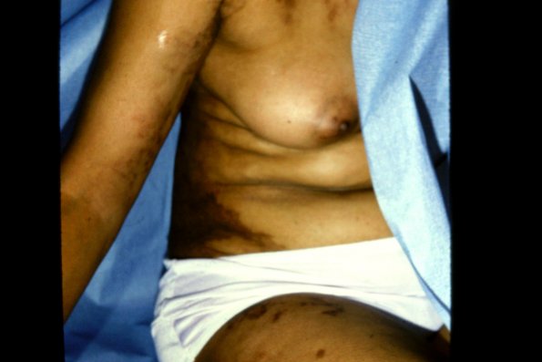 Linear Scleroderma Morphea