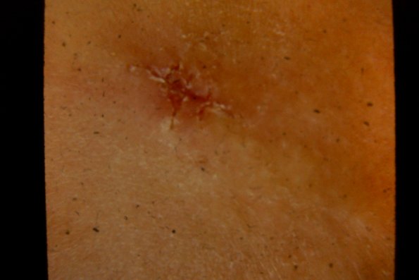 Morphea (7)