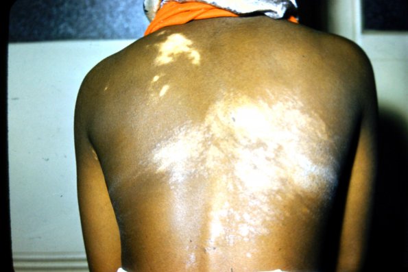 Scleroderma Morphea Localized