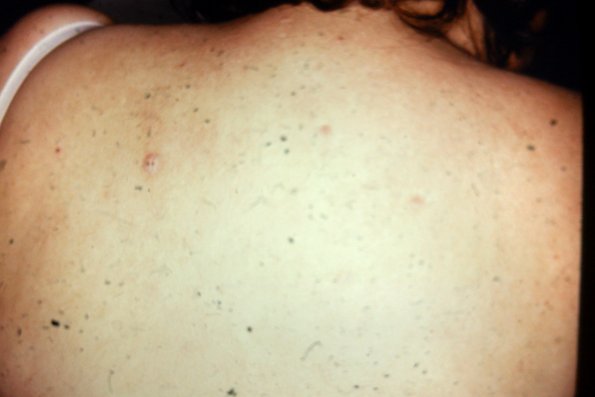 Papular Mucinosis (2)