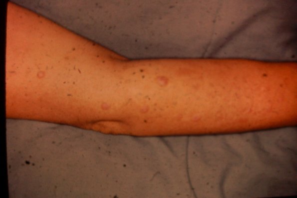 Papular Mucinosis (5)