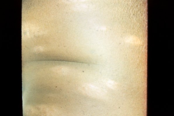 Mycosis Fungoide