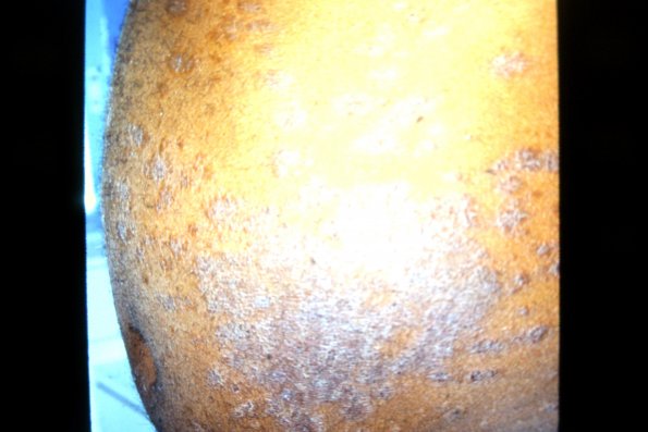 Mycosis Fungoides (10)