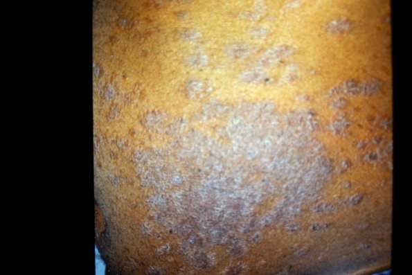 Mycosis Fungoides (11)