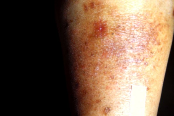Mycosis Fungoides (12)