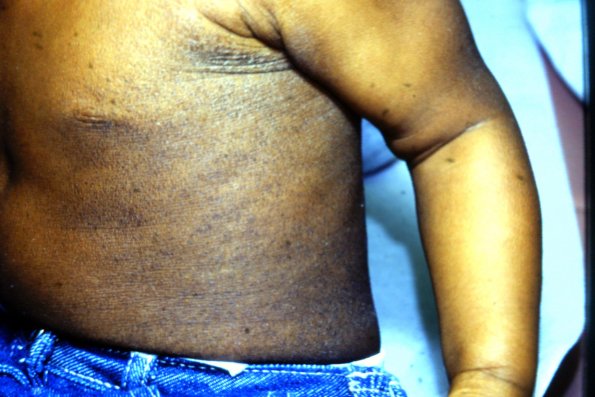 Mycosis Fungoides (14)