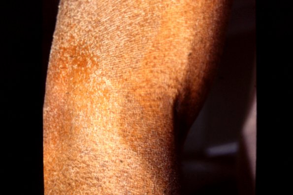 Mycosis Fungoides (16)