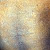 Mycosis Fungoides (17)