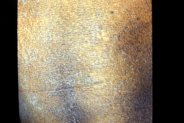 Mycosis Fungoides (17)
