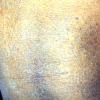 Mycosis Fungoides (18)