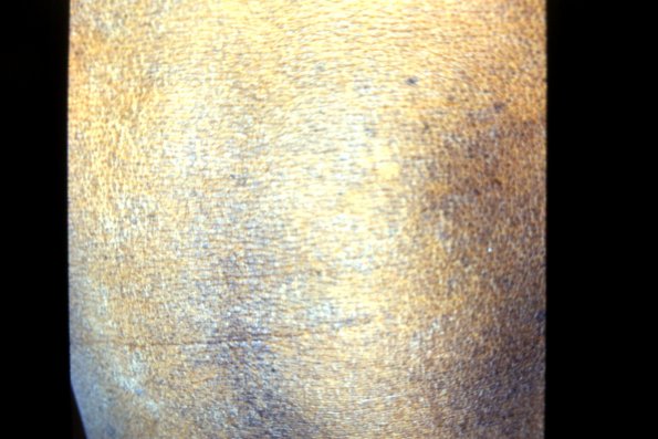 Mycosis Fungoides (18)