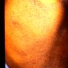 Mycosis Fungoides (19)
