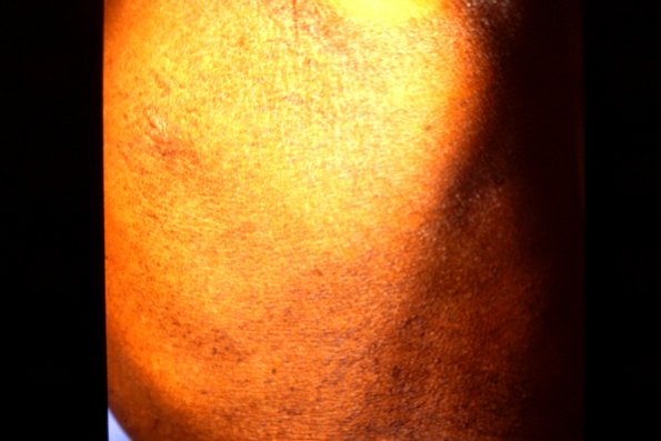 Mycosis Fungoides (19)
