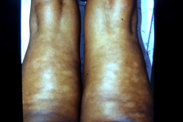 Mycosis Fungoides (2)