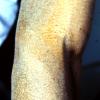 Mycosis Fungoides (20)