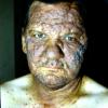 Mycosis Fungoides (21)