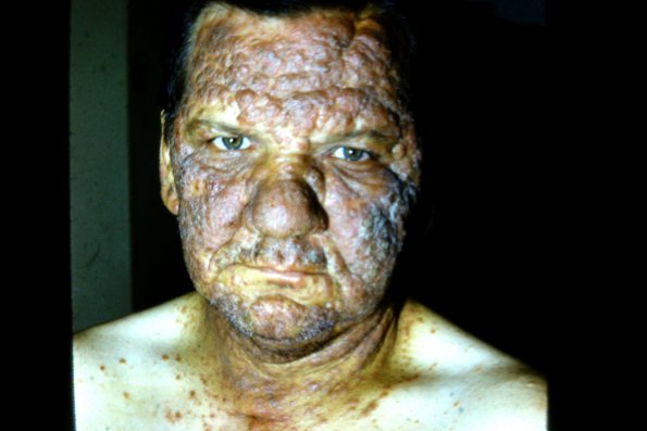 Mycosis Fungoides (21)