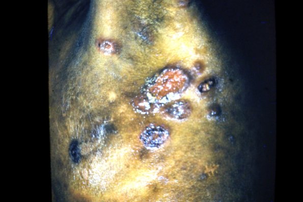 Mycosis Fungoides (22)