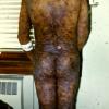 Mycosis Fungoides (23)