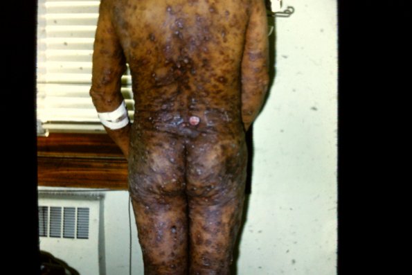 Mycosis Fungoides (23)