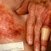 Mycosis Fungoides (24)