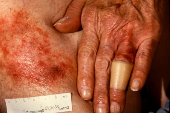 Mycosis Fungoides (24)