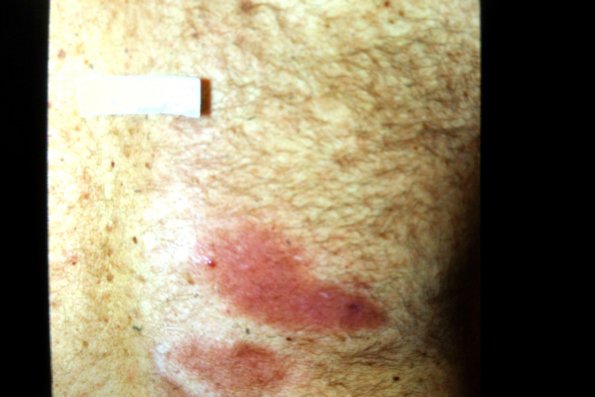 Mycosis Fungoides (25)
