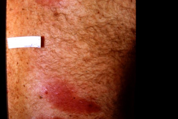 Mycosis Fungoides (27)