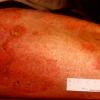 Mycosis Fungoides (28)