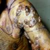 Mycosis Fungoides (29)