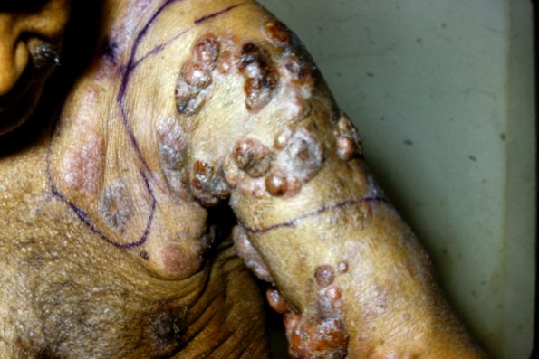 Mycosis Fungoides (29)