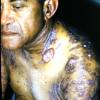 Mycosis Fungoides (30)