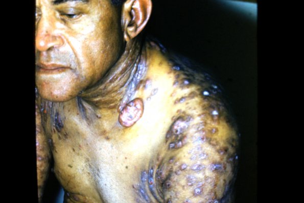 Mycosis Fungoides (30)