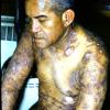 Mycosis Fungoides (31)