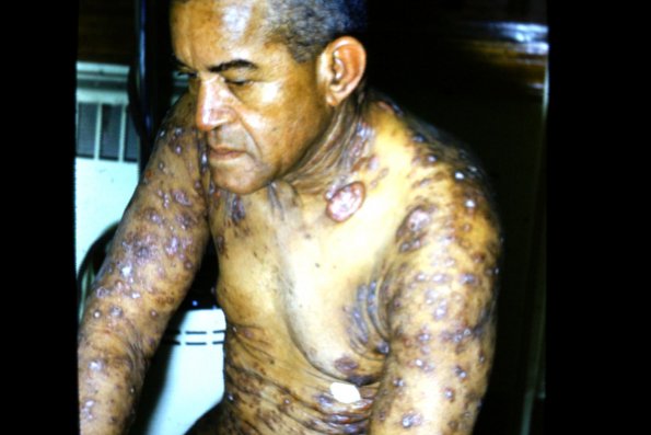 Mycosis Fungoides (31)