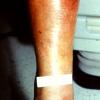 Mycosis Fungoides (32)
