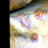 Mycosis Fungoides (33)