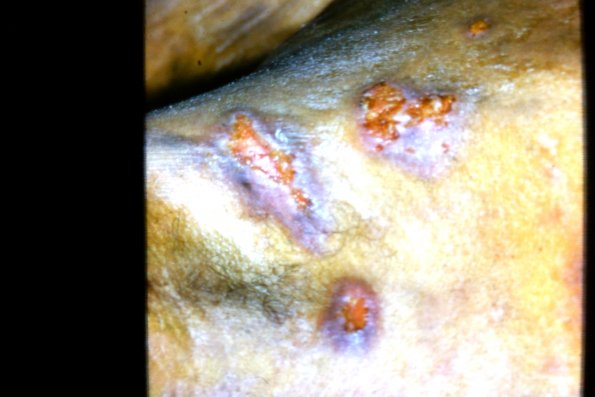 Mycosis Fungoides (33)