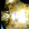 Mycosis Fungoides (34)