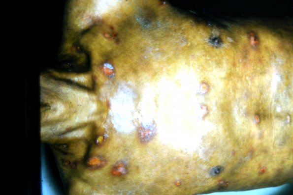 Mycosis Fungoides (34)