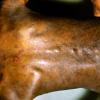 Mycosis Fungoides (35)