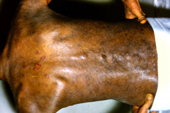 Mycosis Fungoides (35)