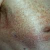 Mycosis Fungoides (36)