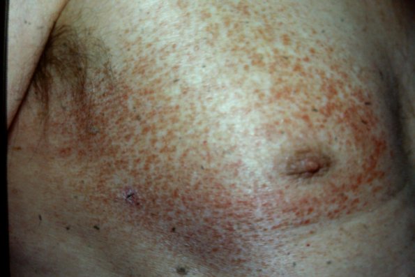 Mycosis Fungoides (36)